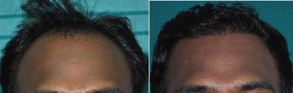 Photo of hair transplant in Ernakulam result