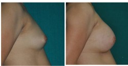 breast implant before after
